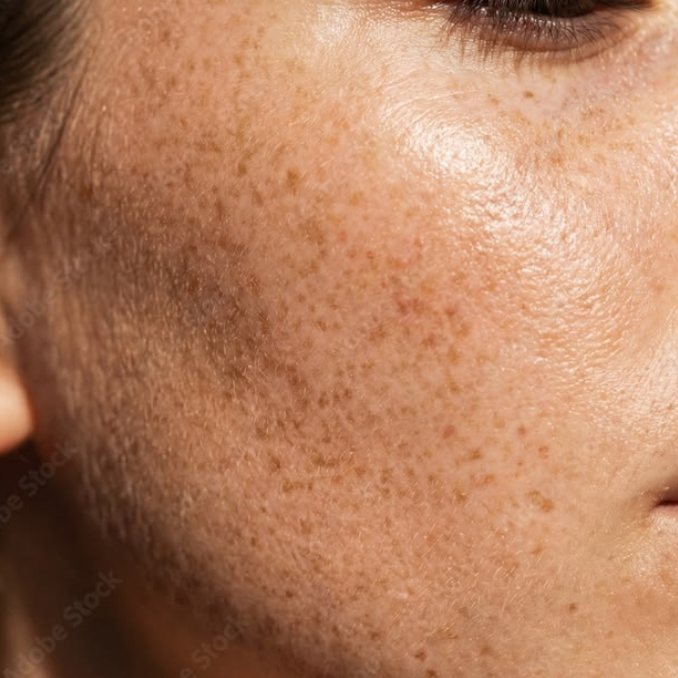 How Long Does Laser Take to Fade Pigmentation? A Realistic Timeline