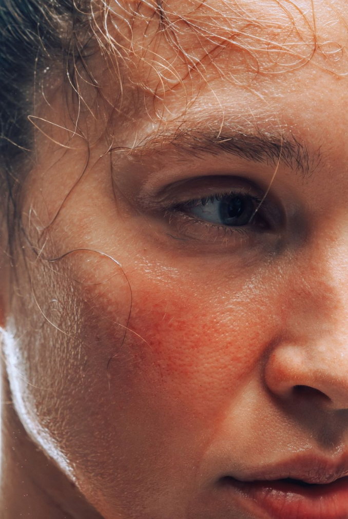 Rosacea Management: A Clinical Guide for Sydney Skin