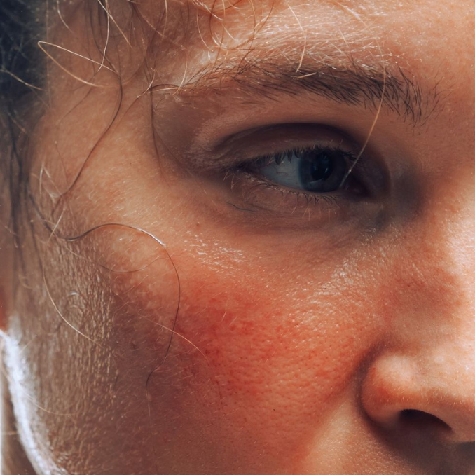 Rosacea Management: A Clinical Guide for Sydney Skin