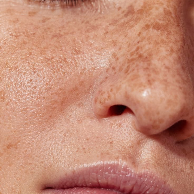 Sun Damage Repair in Sydney: What Actually Works, and When to Start