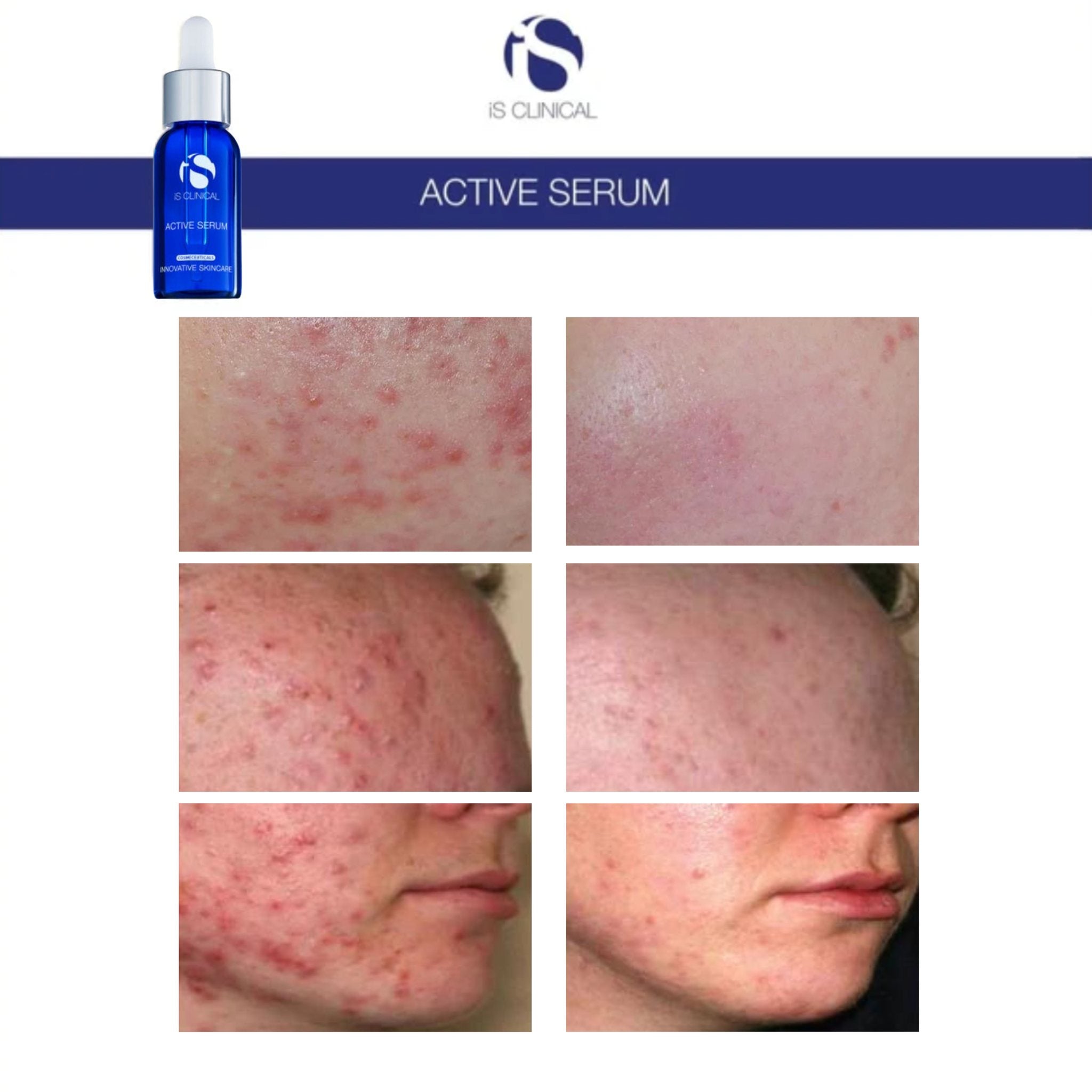 iS Clinical Active Serum