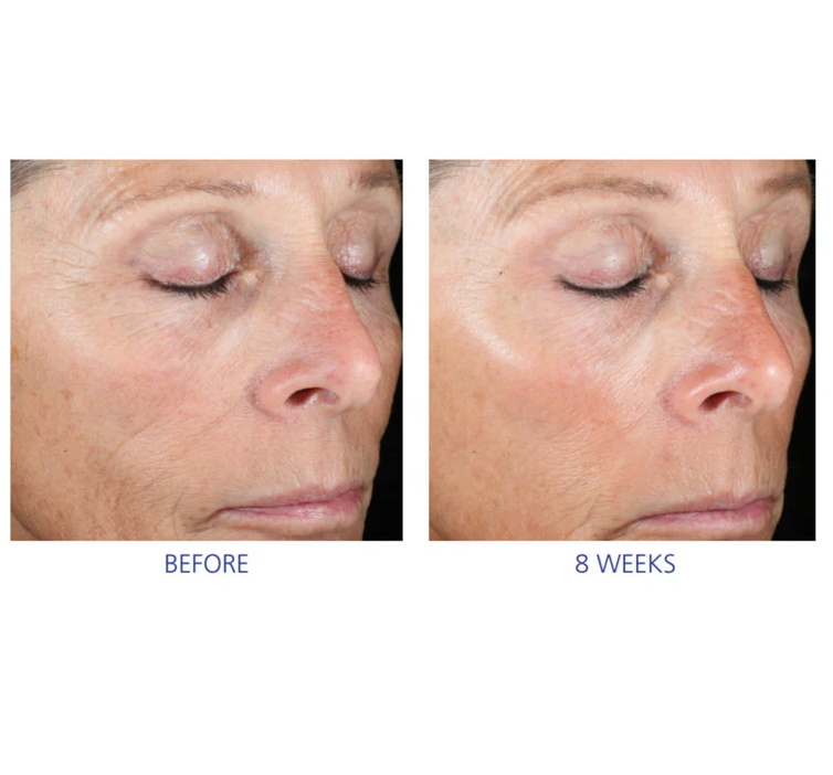 iS Clinical Active Peel System