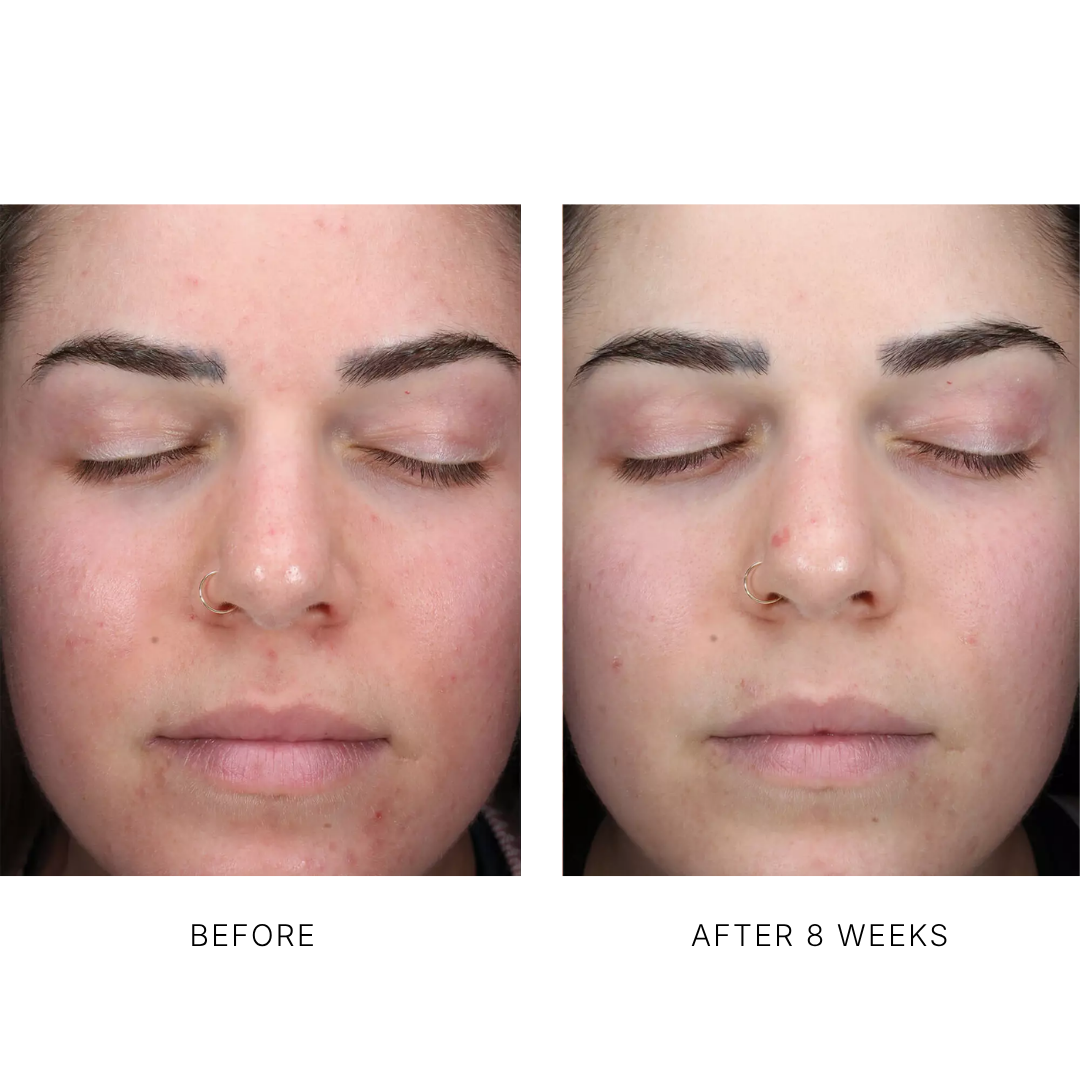 AlphaRet Clearing Serum